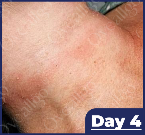 Fivfivgo™ NatureErase Instant Mole & Spot Removal Gel image Fivfivgo™ NatureErase Instant Mole & Spot Removal Gel