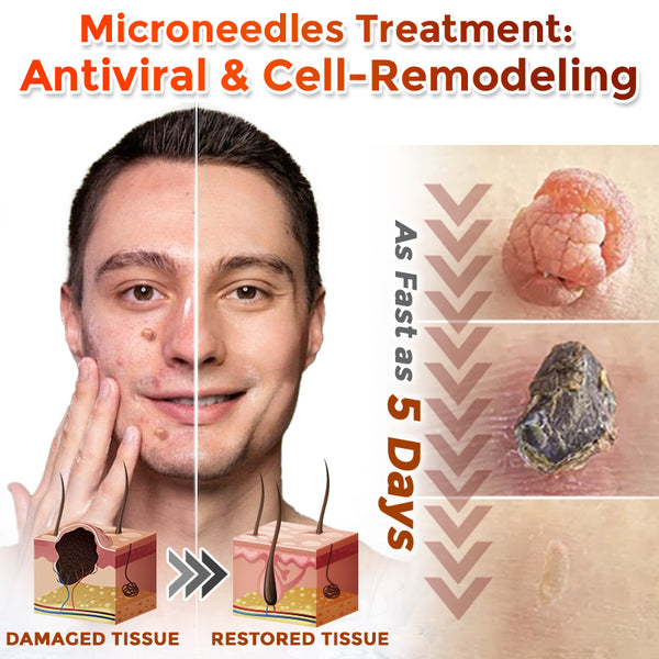 Yunpso™ MicroNeedle Botanic Skin Tag Removal Patch