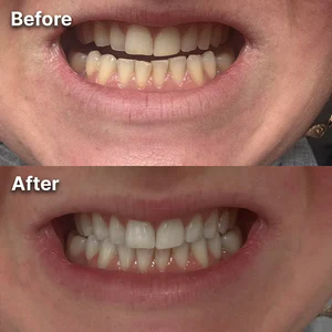 Miraloud™ Tooth Polish - Instant Clean Smile