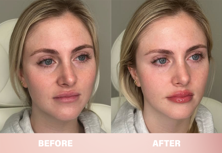 LIMETOW® Lip Plumper Kit image LIMETOW® Lip Plumper Kit