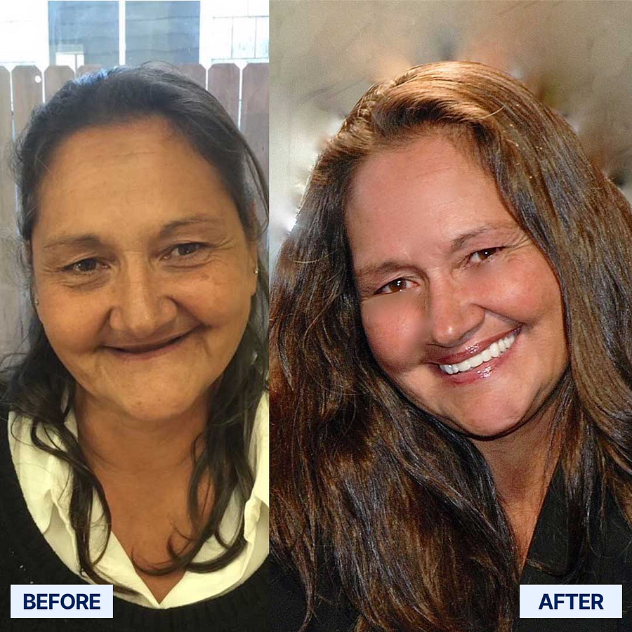 ROSOPLTM Custom-Fit Full Functional Dentures 20