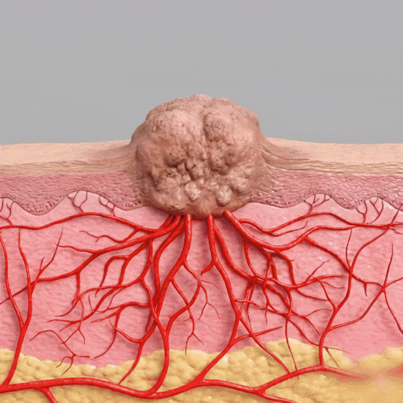 Timilk® WartLift Corn Removal Liquid (A)