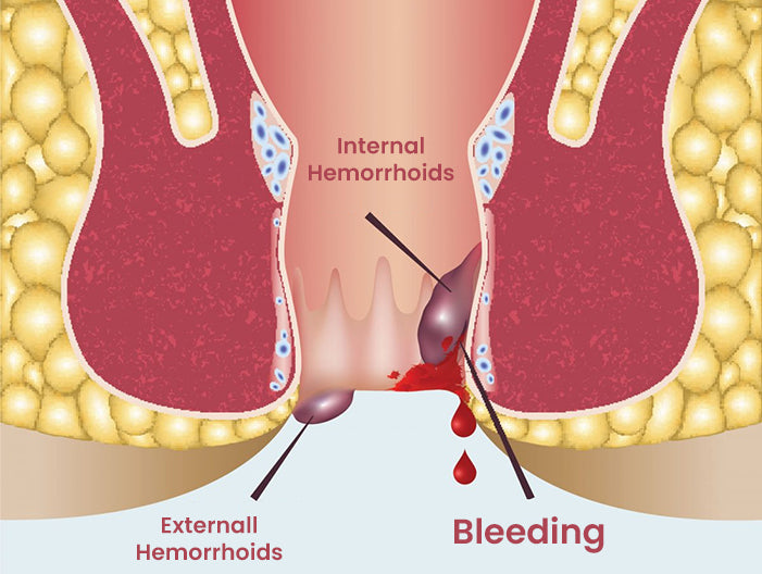 Cvreoz® Herbal Hemorrhoid Treatment Anal Spray