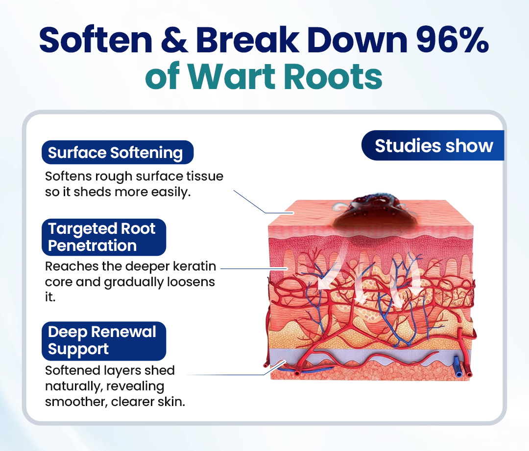 Timilk® WartLift Corn Removal Liquid (A)
