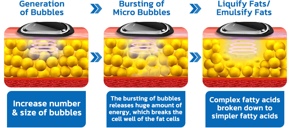 🧑‍⚕️NESLEMY™ Ultrasonic Fat Blasting and Detoxing Wristband B