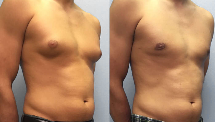 AnnieCare® ThermoFirm Bee Venom Gynecomastia-Oil 20 AnnieCare® ThermoFirm Bee Venom Gynecomastia-Oil