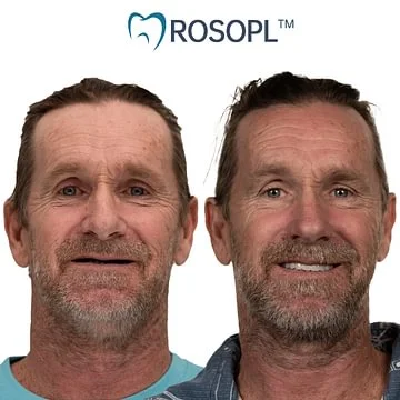 ROSOPL™ Functional Dentures – Dentist Recommended for Seniors 45+ | Made in USA | FDA Cleared