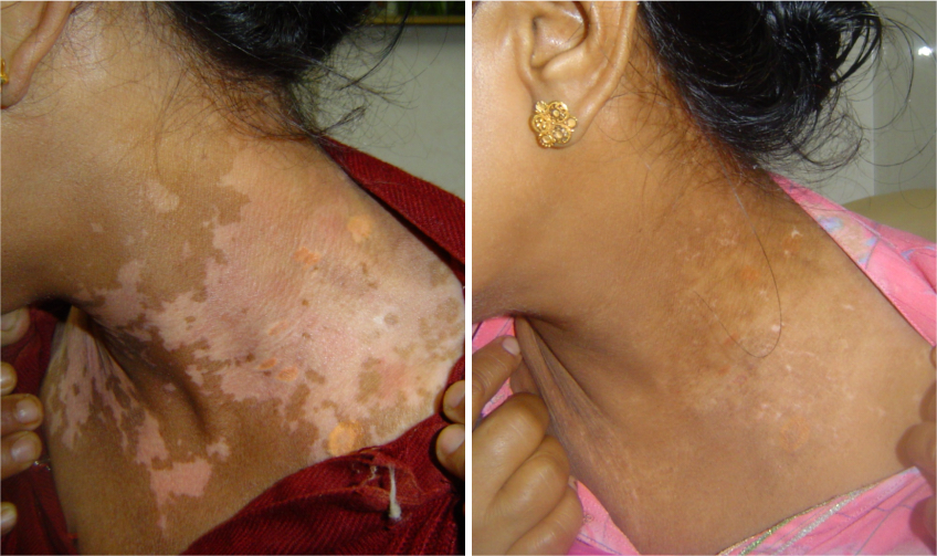 YUNPSO® VitiHeali Yellowjacket Neurotoxic fluid Extractm Cream Ultra 27 YUNPSO® VitiHeali Yellowjacket Neurotoxic fluid Extractm Cream Ultra