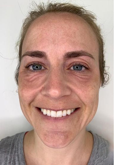 Furzero™ Botox anti-wrinkle serum with bee venom