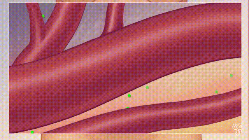 Después del tratamiento.gif