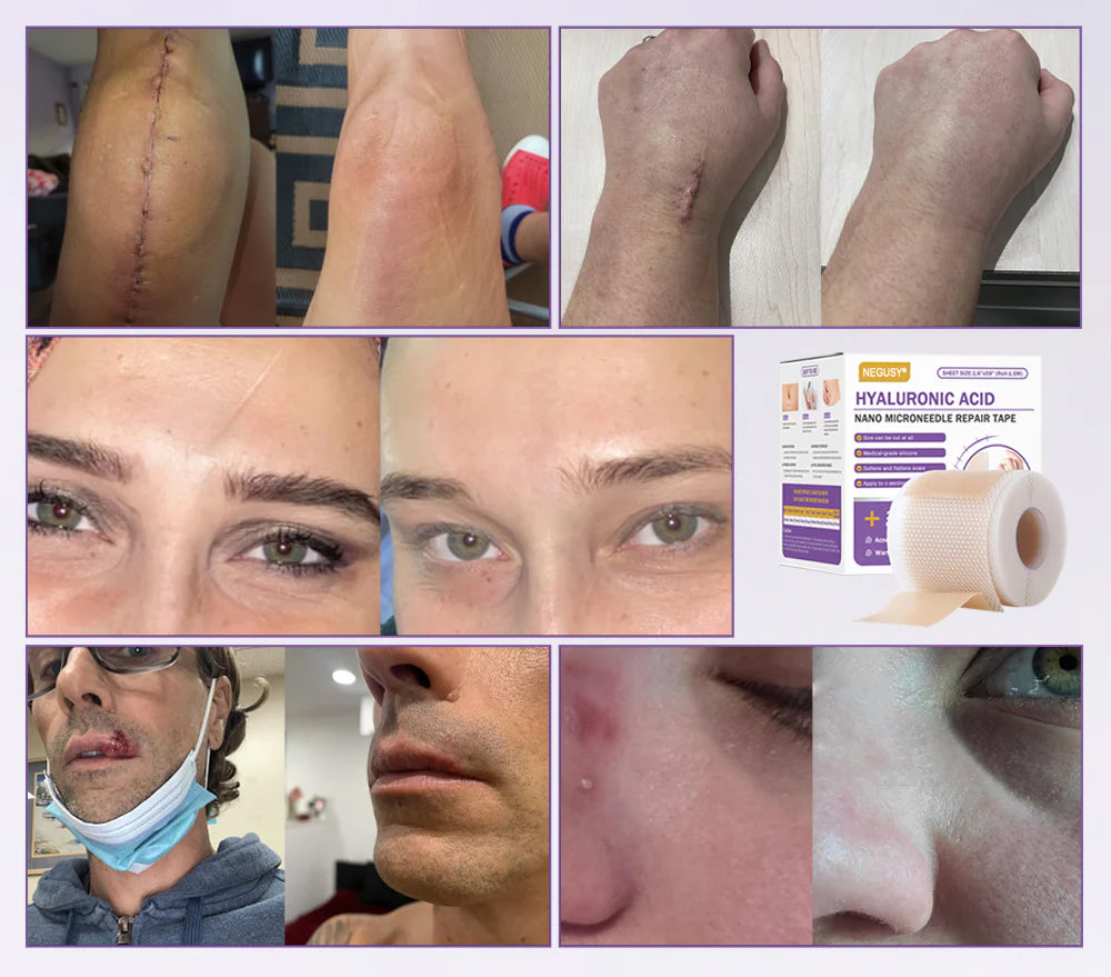 Bostore® hyaluronic acid nano micro-needle regenerating patch image Bostore® hyaluronic acid nano micro-needle regenerating patch