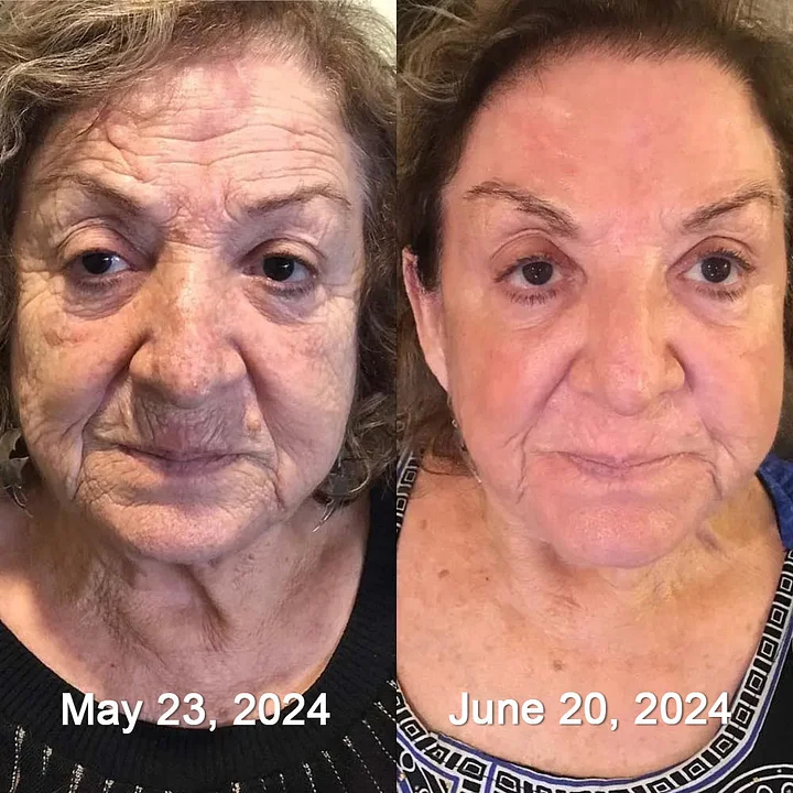 Rolimey® Botox & Vita-A Retinol Firming & Anti-Wrinkle Serum