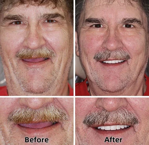 LAOZIK™-Advanced Custom-Fit Functional Dentures