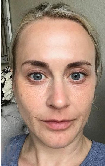 Furzero™ Botox anti-wrinkle serum with bee venom