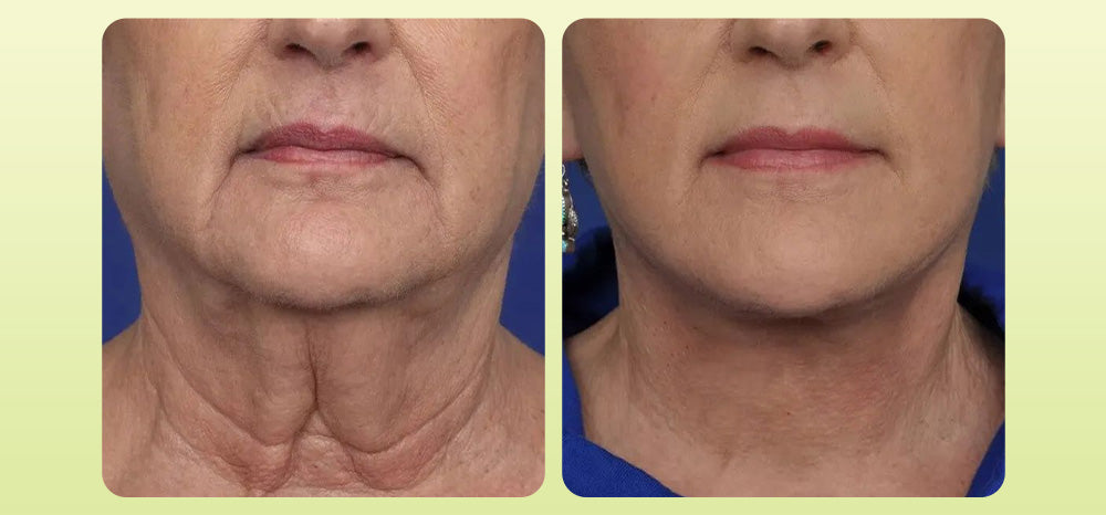 Zvoevo® VitaBotox Firming Elixir combines Botox 38 3fc5d476a715c81018628fcbcd116164