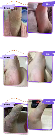 HZA™ FungiVanish Foot Treatment Spray