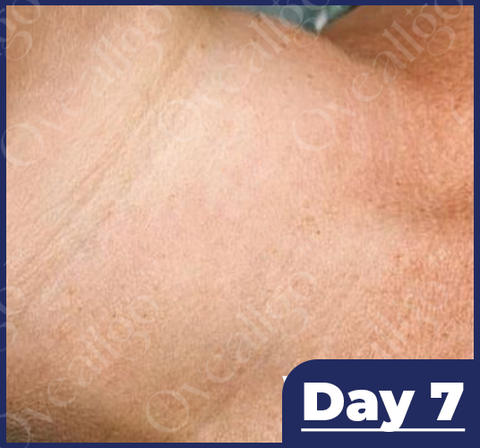 Fivfivgo™ NatureErase Instant Mole & Spot Removal Gel image Fivfivgo™ NatureErase Instant Mole & Spot Removal Gel