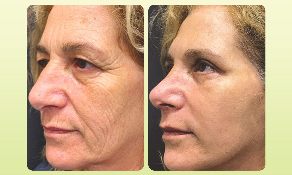 Zvoevo® VitaBotox Firming Elixir combines Botox 37 4977d7ec37c8e05322ffb3ea2fe58bdc