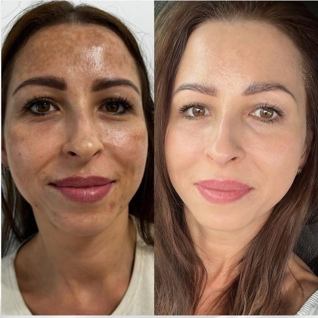 Furzero™ EPIGLOW MelanEX Advanced Cream