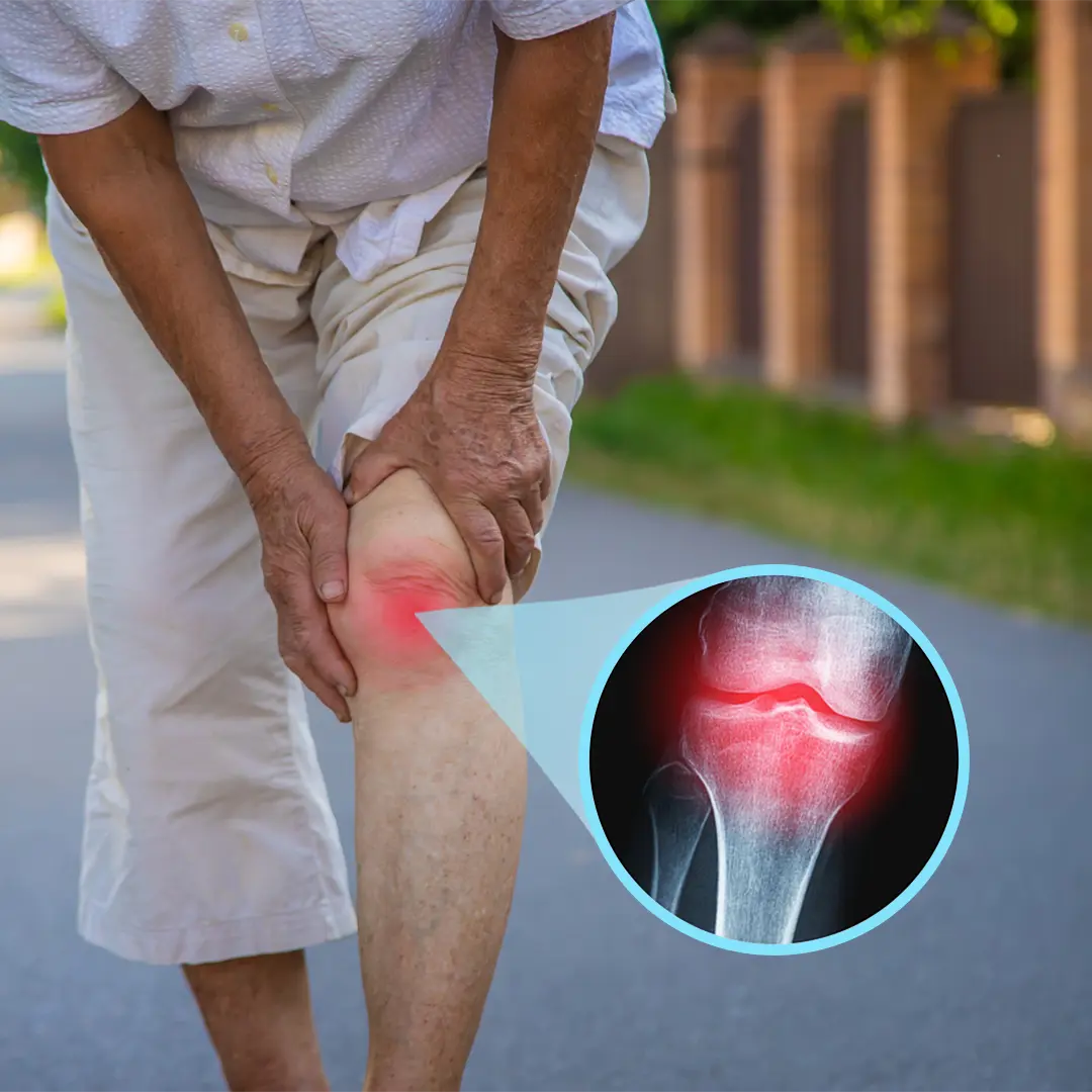 An elderly person holding their knee with pain highlight and an inset of a knee X-ray.