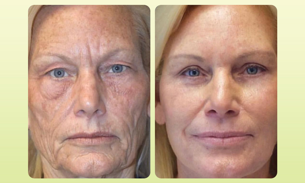 Zvoevo® VitaBotox Firming Elixir combines Botox 36 51d68bad0746e3aacc0f73927cf3e7bd