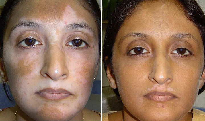 YUNPSO® VitiHeali Yellowjacket Neurotoxic fluid Extractm Cream Ultra 25 YUNPSO® VitiHeali Yellowjacket Neurotoxic fluid Extractm Cream Ultra