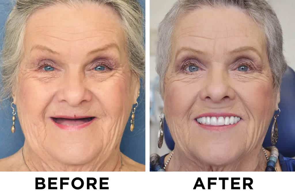 LAOZIK-Advanced customized complete denture set 20 LAOZIK-Advanced customized complete denture set