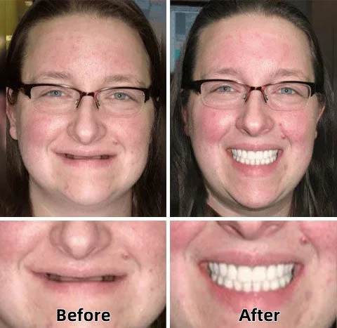 LAOZIK™-Advanced Custom-Fit Functional Dentures