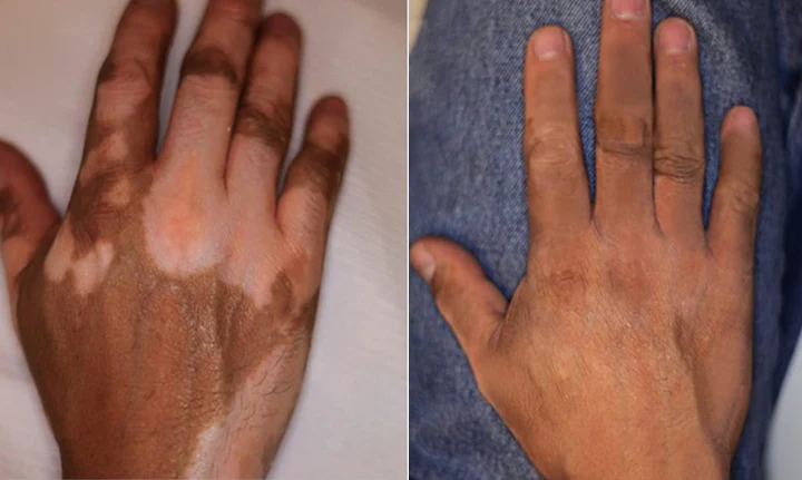 YUNPSO® VitiHeali Yellowjacket Neurotoxic fluid Extractm Cream Ultra 44 YUNPSO® VitiHeali Yellowjacket Neurotoxic fluid Extractm Cream Ultra