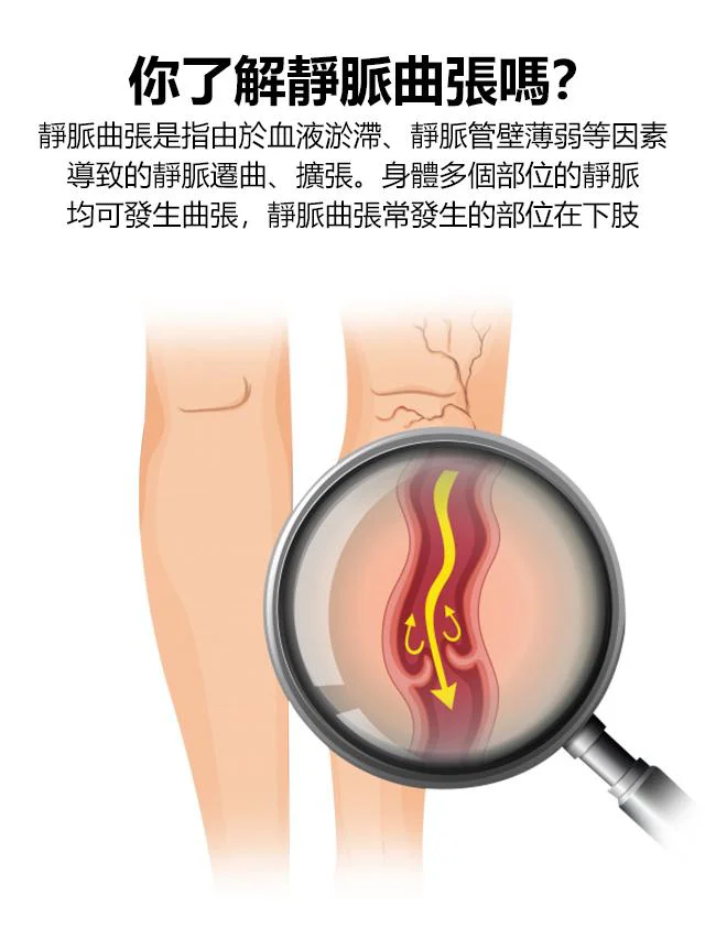 靜脈曲張貼片