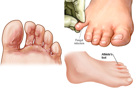 HZA™ FungiVanish Foot Treatment Spray