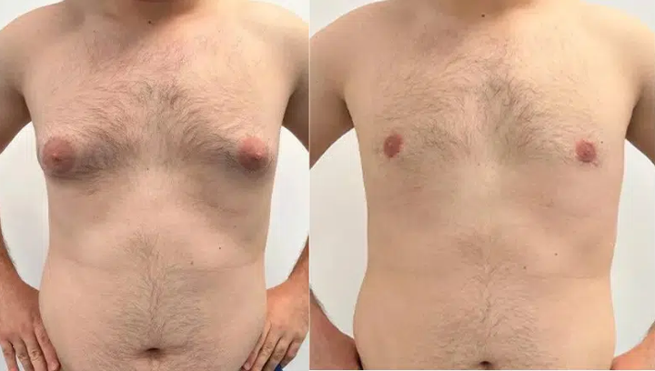 AnnieCare® ThermoFirm Bee Venom Gynecomastia-Oil 26 AnnieCare® ThermoFirm Bee Venom Gynecomastia-Oil