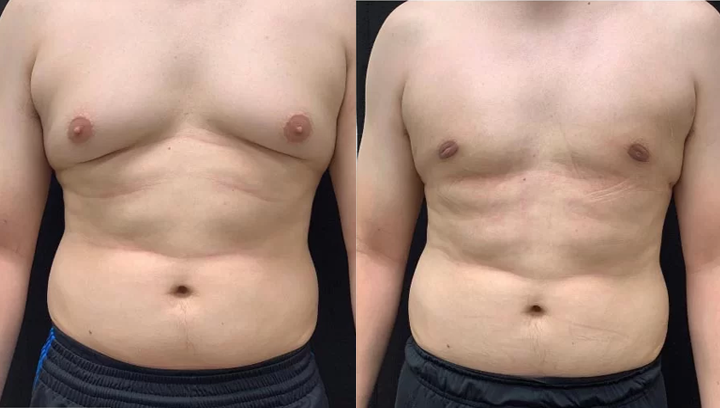 AnnieCare® ThermoFirm Bee Venom Gynecomastia-Oil 19 AnnieCare® ThermoFirm Bee Venom Gynecomastia-Oil