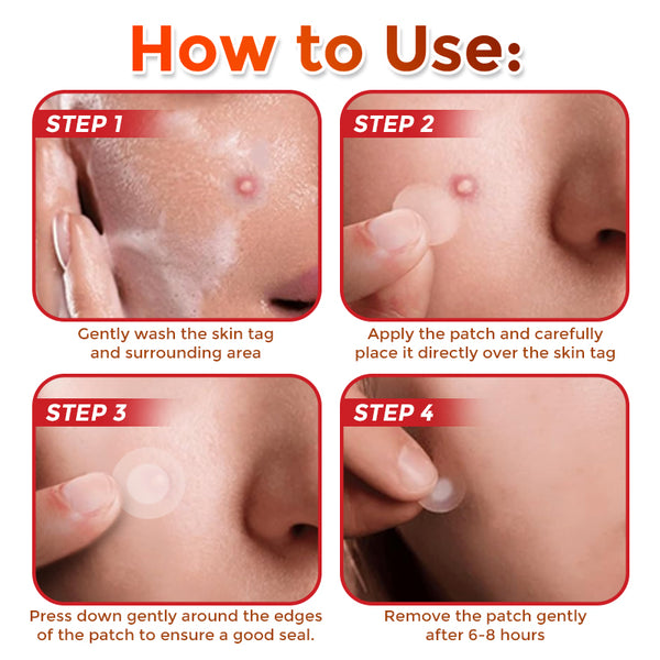 Yunpso™ MicroNeedle Botanic Skin Tag Removal Patch