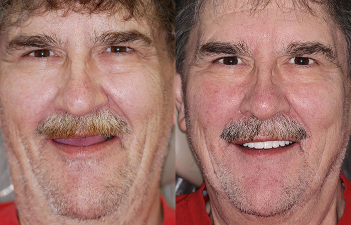LAOZIK™ Custom-Fit Functional Dentures — Perfectly Fitted in Minutes at Home