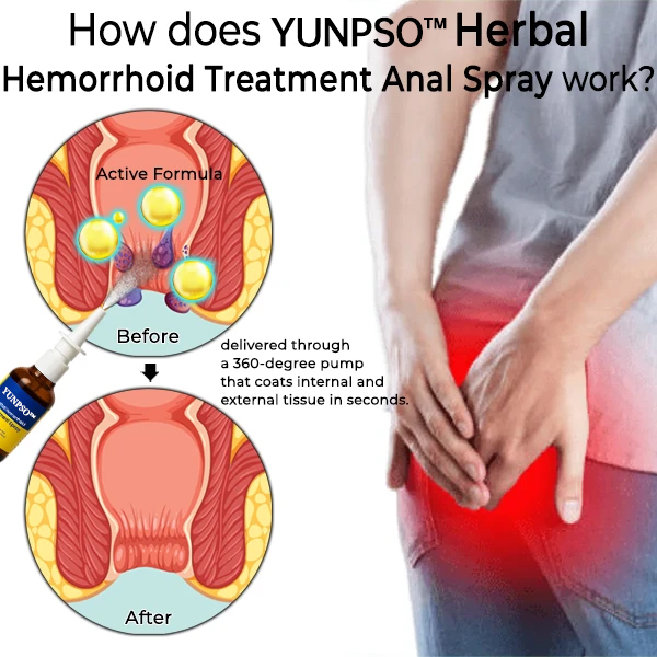YUNPSO® Herbal Hemorrhoid Treatment Anal Spray Pro 19 6744df1838724f17514674d97b862118