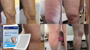 BQYOOM™ VenaRestore MicroNeedle Vein Repair Patch