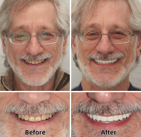 LAOZIK™-Advanced Custom-Fit Functional Dentures