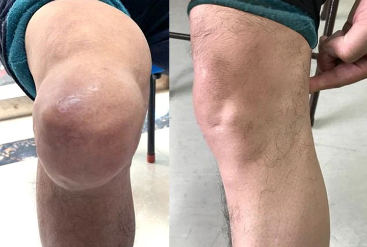 Caselast® Premium Curcumin Pain Relief Gel 25 Caselast® Premium Curcumin Pain Relief Gel