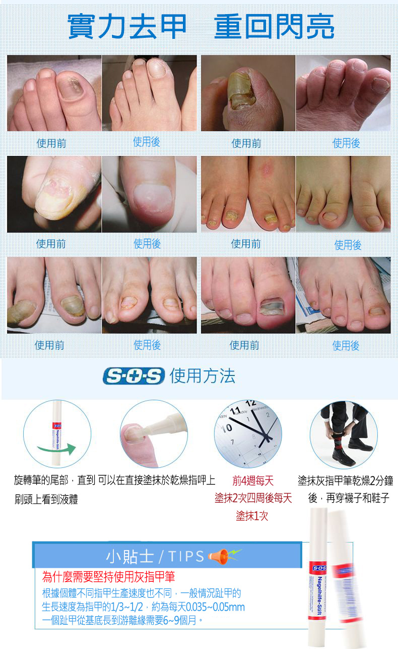 德國SOS灰指甲修復筆