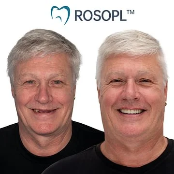 ROSOPL™ Functional Dentures – Dentist Recommended for Seniors 45+ | Made in USA | FDA Cleared