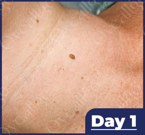 Fivfivgo™ NatureErase Instant Mole & Spot Removal Gel image Fivfivgo™ NatureErase Instant Mole & Spot Removal Gel