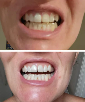 Miraloud™ Tooth Polish - Instant Clean Smile