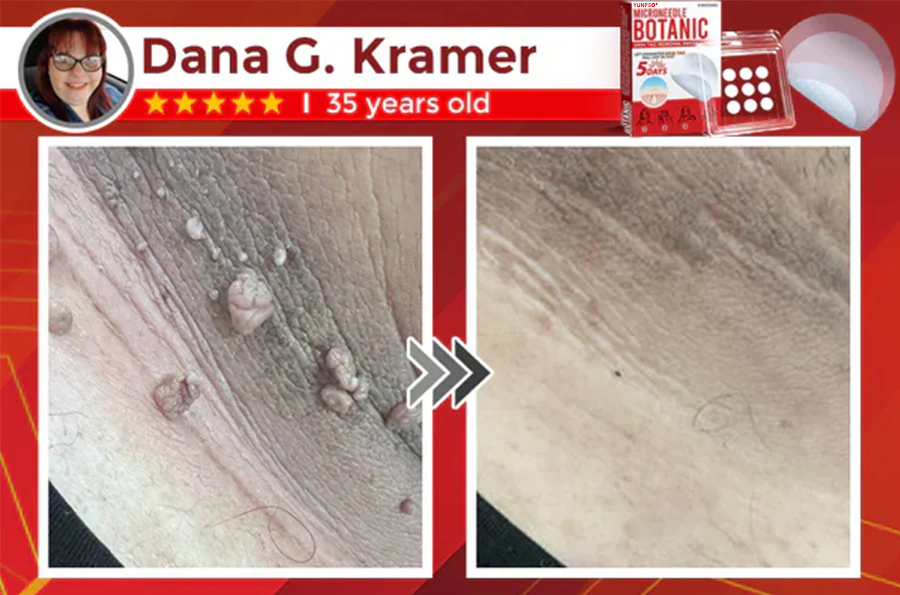 Yunpso™ MicroNeedle Botanic Skin Tag Removal Patch