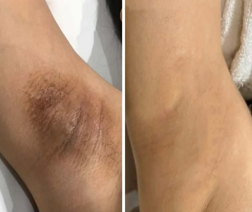 Furzero™ EPIGLOW MelanEX Advanced Cream