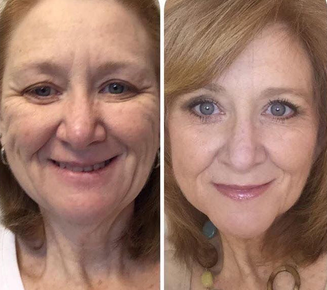 Furzero™ Botox anti-wrinkle serum with bee venom