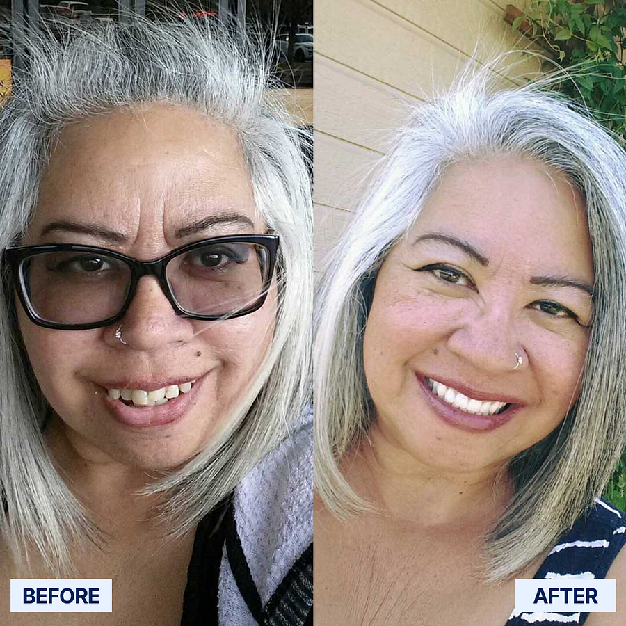 ROSOPLTM Custom-Fit Full Functional Dentures 21