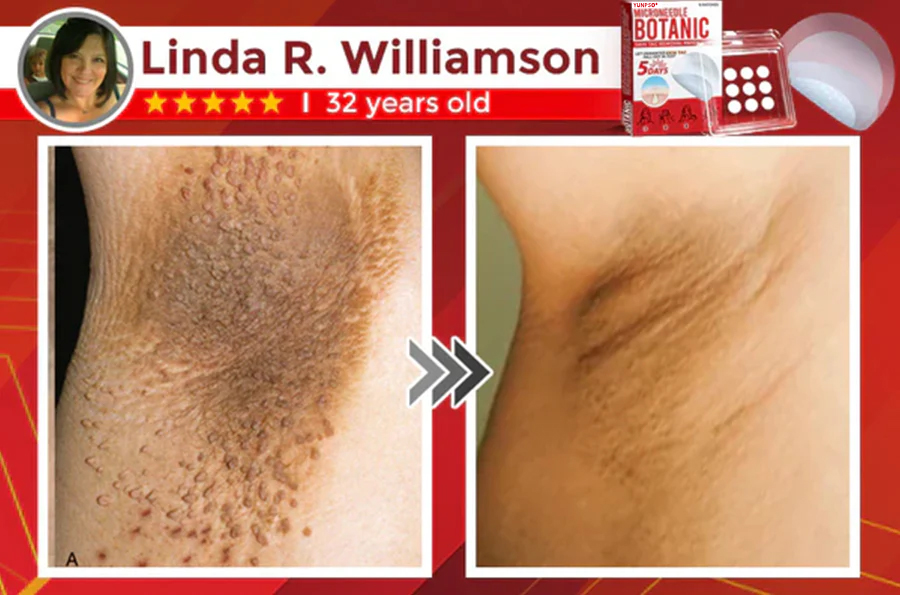 Yunpso™ MicroNeedle Botanic Skin Tag Removal Patch