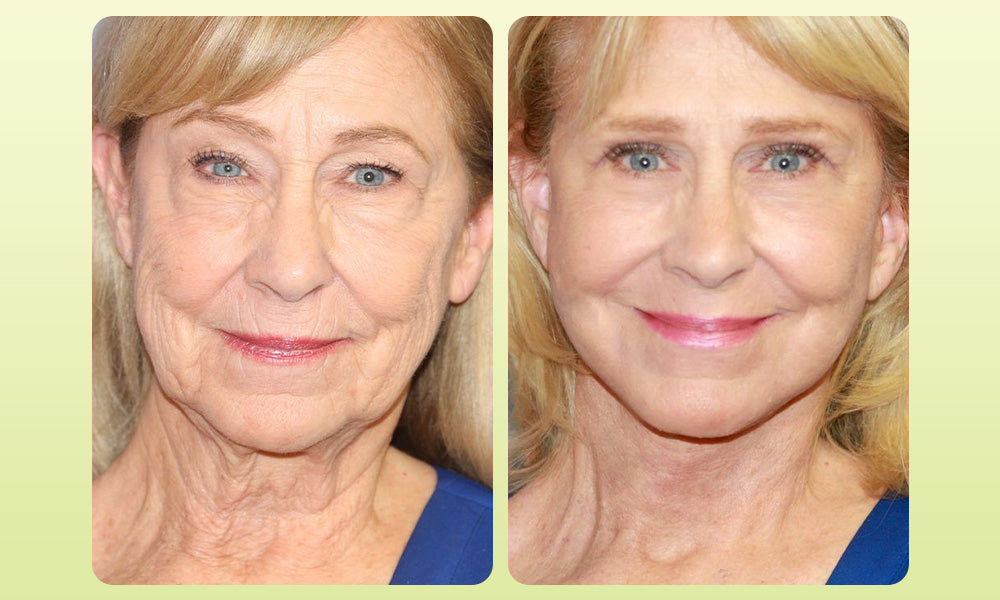 Zvoevo® VitaBotox Firming Elixir combines Botox 35 9034eeb2c538fb81d8b8821046c564c3