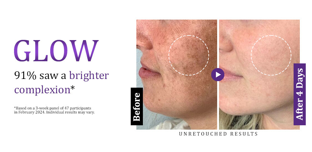 Furzero™ EPIGLOW MelanEX Advanced Cream